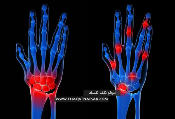 وصفات هامة في علاج إلتهاب مفاصل اليدين وصفات هامة في علاج إلتهاب مفاصل اليدين