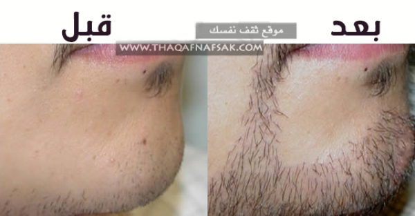 طرق زيادة شعر اللحية الخفيف عند الرجال طرق زيادة شعر اللحية الخفيف عند الرجال