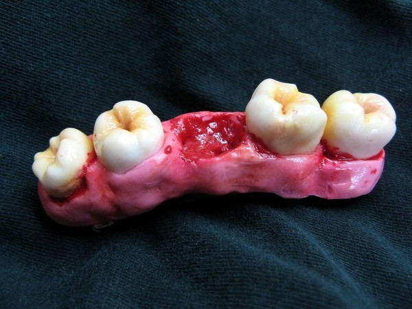 أعرف أسباب وحلول مشكلة نزيف اللثة أثناء تنظيف الأسنان وعالجها بنفسك