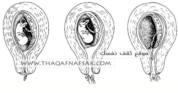 أسباب الإجهاض و طرق تثبيت الحمل أسباب الإجهاض و طرق تثبيت الحمل