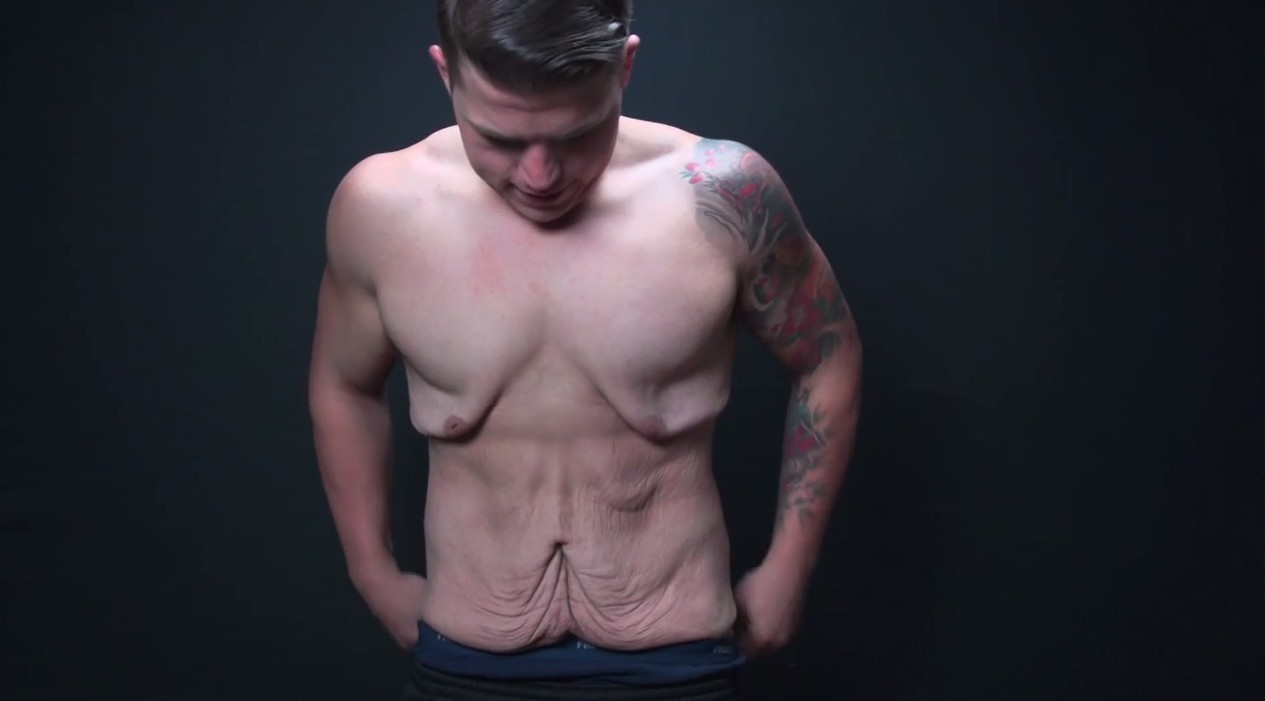 أسباب ترهل الجلد بعد فقدان الوزن وطرق علاجه