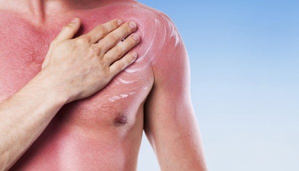 10 علاجات منزلية تساعد في علاج حروق الشمس 10 علاجات منزلية تساعد في علاج حروق الشمس