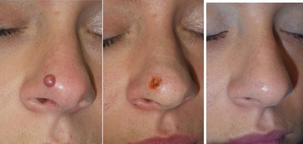 طرق طبيعية وفعالة للتخلص من شامات الوجه