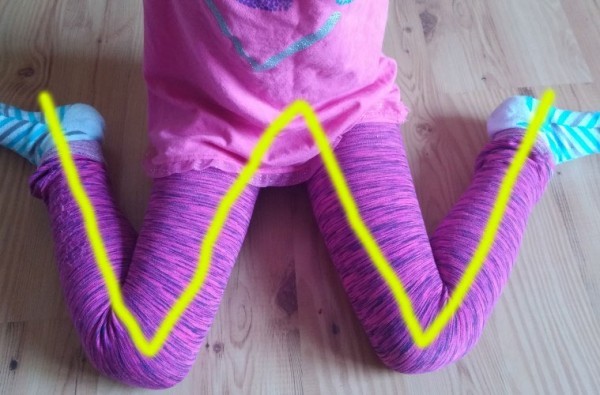 إحذر جلوس الطفل في وضعية W