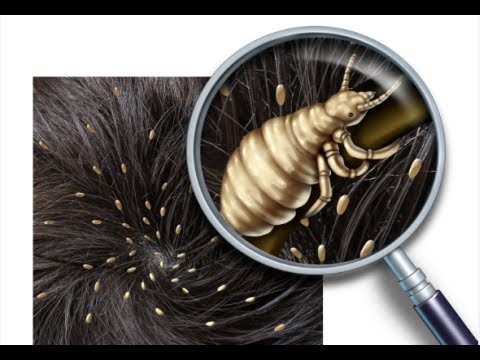 ١٨ طريقة لعلاج حشرات الشعر والتخلص منها ١٨ طريقة لعلاج حشرات الشعر والتخلص منها