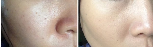 أسباب مسام البشرة الواسعة وكيفية تصغيرها والعناية بها