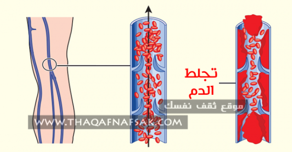 أسباب تجلط الدم عند الحامل والعلاج والوقاية أسباب تجلط الدم عند الحامل والعلاج والوقاية