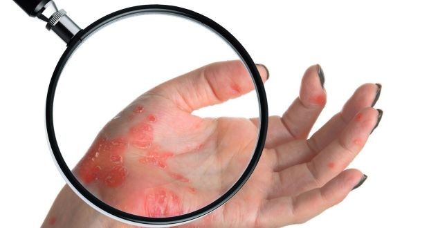 7 أطعمة تجعل مرض الصدفية أكثر سوءاً 7 أطعمة تجعل مرض الصدفية أكثر سوءاً