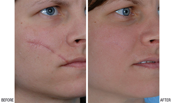 طرق علاج اثار الجروح القديمة طبيعياً