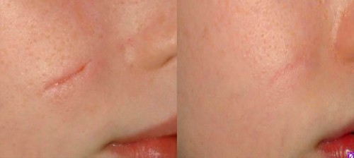 طرق علاج اثار الجروح القديمة طبيعياً طرق علاج اثار الجروح القديمة طبيعياً