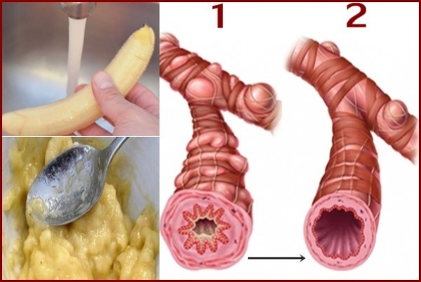 ١٨وصفة لعلاج التهاب الشعب الهوائية