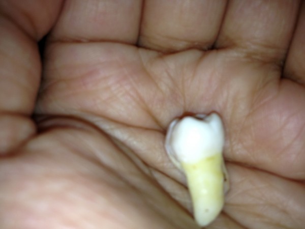 فوائد ضرس العقل والأسباب التي تحُتم عليك خلعه