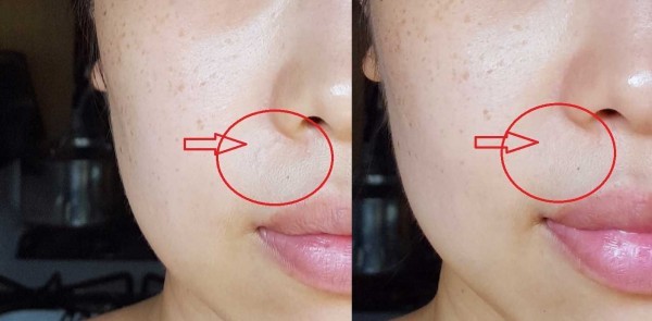 قناع الكار بوكسي وفوائده لحل مشاكل البشرة