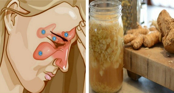 علاج الجيوب الأنفية بمكونين فقط