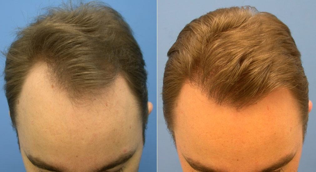 علاج تساقط الشعر بالقرنفل