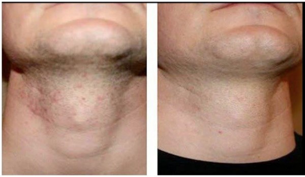 تعرف على الحلاقة بطريقة أمنه ومنع الحبوب من الظهور بعد الحلاقة تعرف على الحلاقة بطريقة أمنه ومنع الحبوب من الظهور بعد الحلاقة
