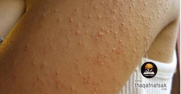 علاج الحبوب تحت الجلد بـ ١٤ طريقة سريعة