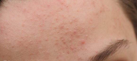 علاج الحبوب تحت الجلد بـ ١٤ طريقة سريعة علاج الحبوب تحت الجلد بـ ١٤ طريقة سريعة