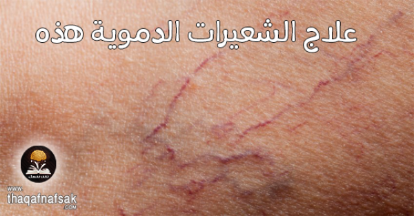 علاج الشعيرات الدموية المنفجرة بـ ١٥ طريقة ومنعها تماماً من الظهور علاج الشعيرات الدموية المنفجرة بـ ١٥ طريقة ومنعها تماماً من الظهور