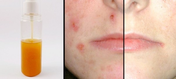 تونر طبيعي لعلاج حب الشباب حضره بنفسك