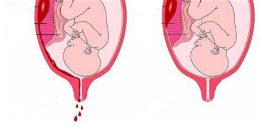 النزيف اثناء الحمل اسبابه وخطورته وكيفيه التغلب عليه