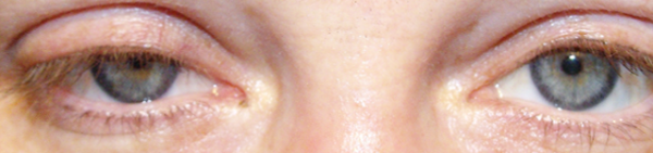 الوهن العضلي الأسباب وطرق العلاج الطبيعية