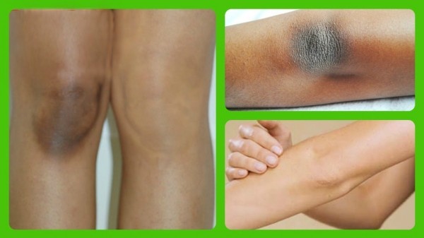 علاج سواد الركبة أسهل مع هذه الوصفات