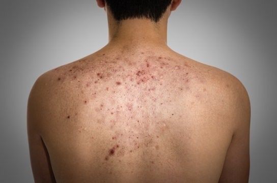 علاج حبوب الظهر بوصفات طبيعية علاج حبوب الظهر بوصفات طبيعية