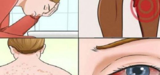 علامات تدل علي أن لديك مرض العفن وما تحتاج إلي معرفته ؟