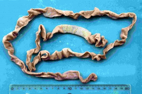 الديدان الشريطية أسباب الإصابة بها وطرق علاجها