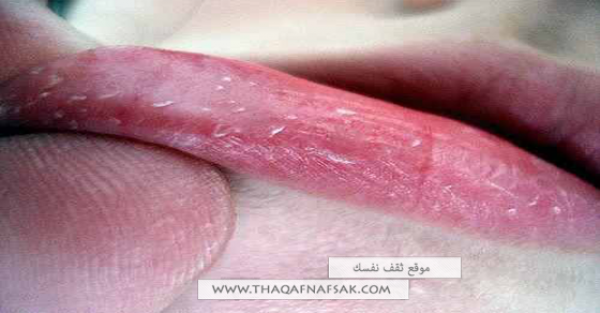 أفضل طرق علاج تشقق الشفاه بتطيبق وصفات طبيعية أفضل طرق علاج تشقق الشفاه بتطيبق وصفات طبيعية