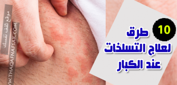 علاج التسلخات عند الكبار بـ ١٠ طرق