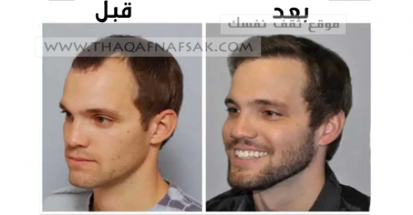 تكثيف شعر الذقن للشباب بوصفات طبيعية تكثيف شعر الذقن للشباب بوصفات طبيعية