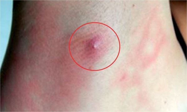 حبوب تحت الإبط الأسباب والعلاج بطرق سريعة