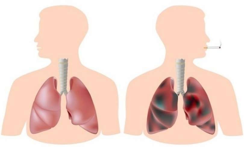 تنظيف الرئة بطرق طبيعية تنظيف الرئة بطرق طبيعية