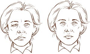 أسباب العصب السابع وطرق العلاج