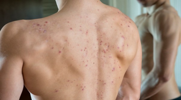 علاج حب الشباب في الظهر بـ 7 خطوات سهلة علاج حب الشباب في الظهر بـ 7 خطوات سهلة