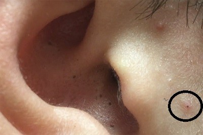 طرق علاج الرؤوس السوداء في الأذن