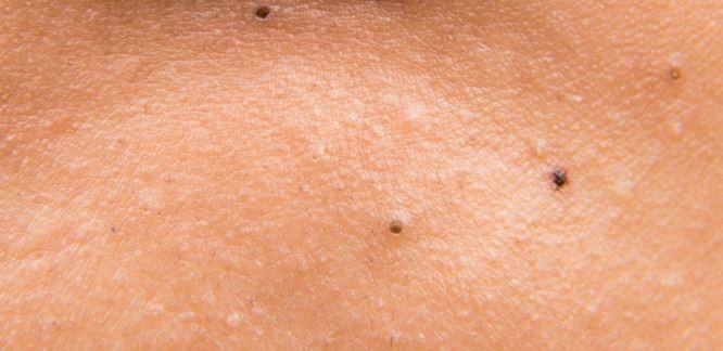 طرق علاج الرؤوس السوداء في الأذن طرق علاج الرؤوس السوداء في الأذن