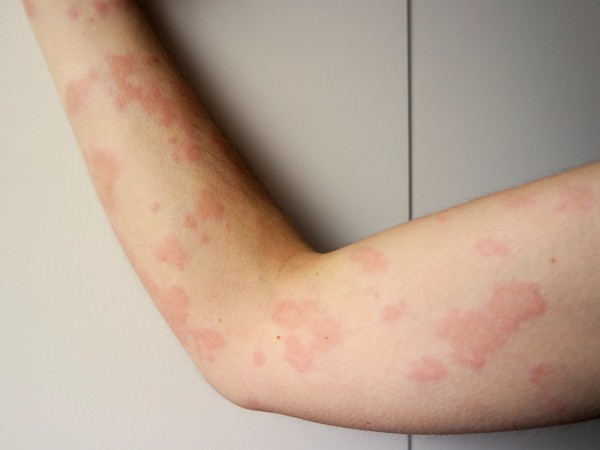 9 علاجات منزلية لحساسية الأرتيكاريا