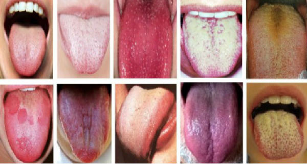 أنواع أمراض اللسان وطرق علاجها والوقاية منها أنواع أمراض اللسان وطرق علاجها والوقاية منها