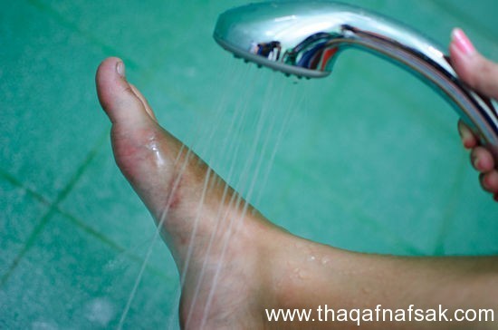 أسباب و علاج مسمار القدم “الكالو” أسباب و علاج مسمار القدم “الكالو”