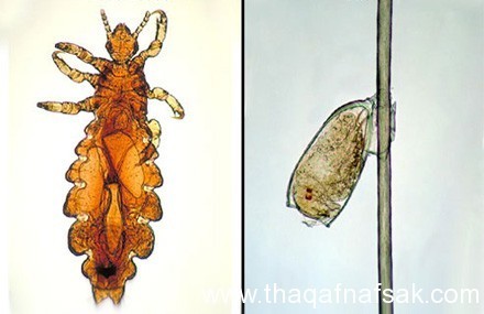 القمل والصيبان الأعراض وكيفية القضاء عليها