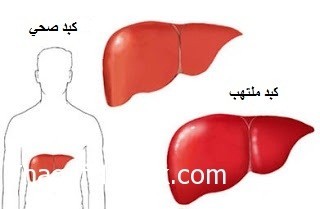 دراسة كاملة عن مرض فيروس سي الكبدي دراسة كاملة عن مرض فيروس سي الكبدي