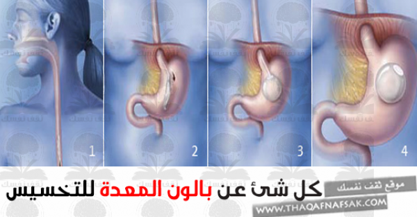 ١٤ سؤال و جواب حول بالون المعدة للتخسيس وهل له نتيجة؟ ١٤ سؤال و جواب حول بالون المعدة للتخسيس وهل له نتيجة؟