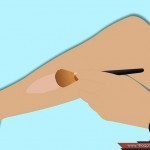 علاج علامات التمدد والخطوط البيضاء على الفخذين والساقين بالصور