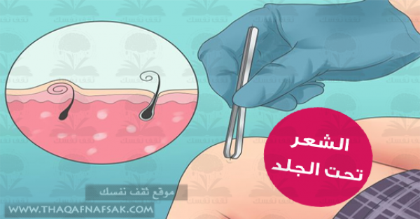 مشكلة نمو الشعر تحت الجلد أسباب وعلاج طبيعي مشكلة نمو الشعر تحت الجلد أسباب وعلاج طبيعي