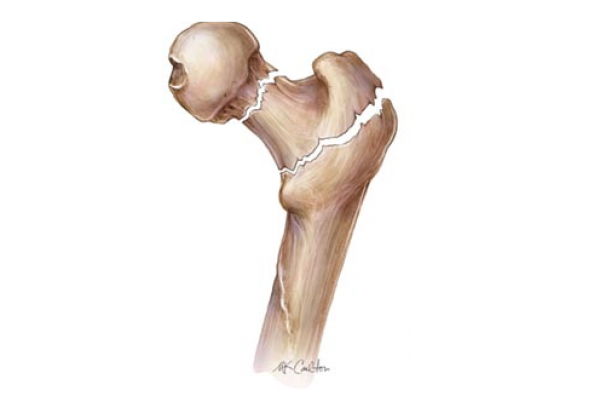 10 نصائح غذائية لمرضى هشاشة العظام