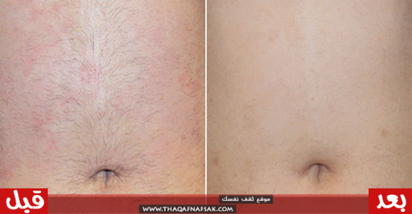 أفكار وخلطات تخلصك من شعر البطن الزائد أفكار وخلطات تخلصك من شعر البطن الزائد