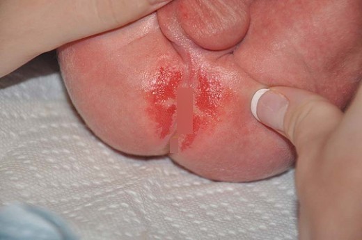 ٨ وصفات تفيد كل أم في علاج تسلخات الأطفال بسبب الحفاضه